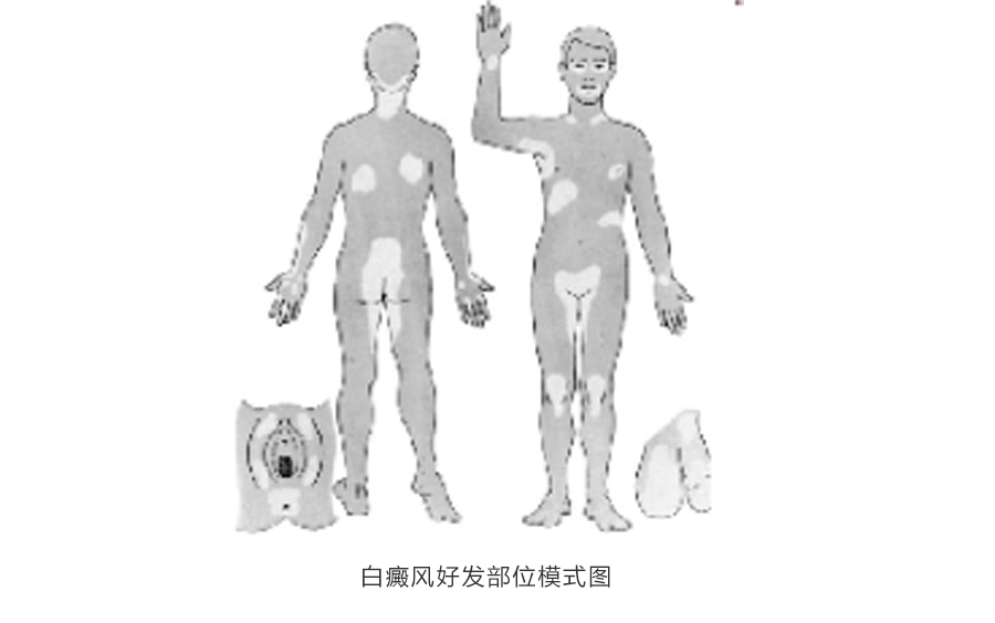 王宏偉教授專欄|白癜風(fēng)相關(guān)知識科普(圖1) 王宏偉教授專欄|白癜風(fēng)相關(guān)知識科普(圖1)